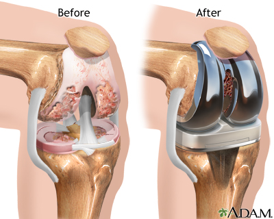 joint replacement