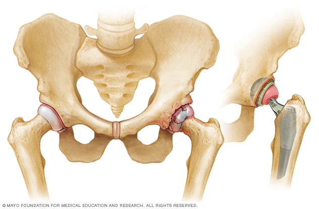 Artificial hip